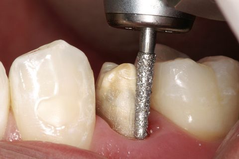 Sửa soạn cùi răng.c (3)